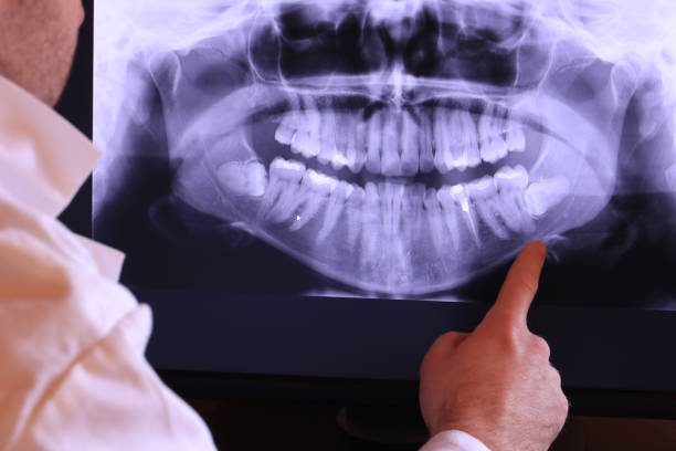 Best Emergency Dentist for Lost Fillings or Crowns in Mendon, UT